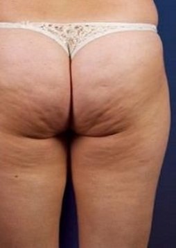 Антицеллюлитный массаж тела до