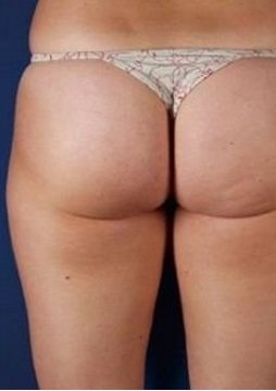 Антицеллюлитный массаж тела после