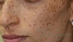 White Gloss by Alma - инновационное лечение пигментации и фотостарения