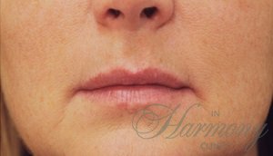 Clear Lift - безболезненное лазерное 4D-омоложение лица на Harmony XL PRO