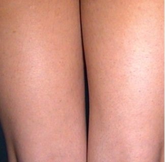 ультразвуковая липосакция после