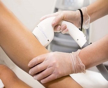 Изображение Лазерная эпиляция диодным лазером