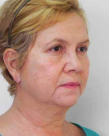 Smas лифтинг до