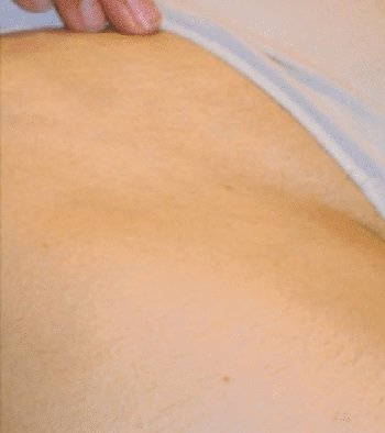 Лазерная эпиляция зоны бикини после