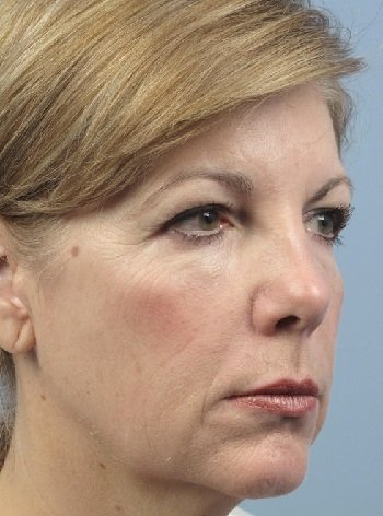 Мезотерапия лица до