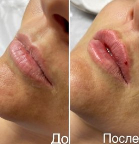 Увеличение губ в технике "Плоский бант"