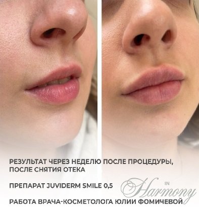 Увеличение губ Juviderm smile 0.5