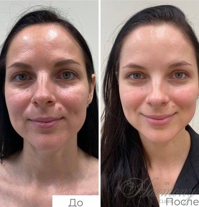 Голливудский уход на аппарате HydraPeel